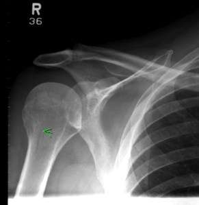 humerus humerus
