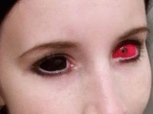 Sclera lenses